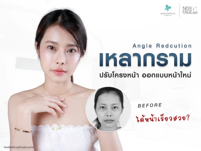 เหลากราม ปรับโครงหน้า ออกแบบหน้าใหม่ ได้หน้าเรียวสวย