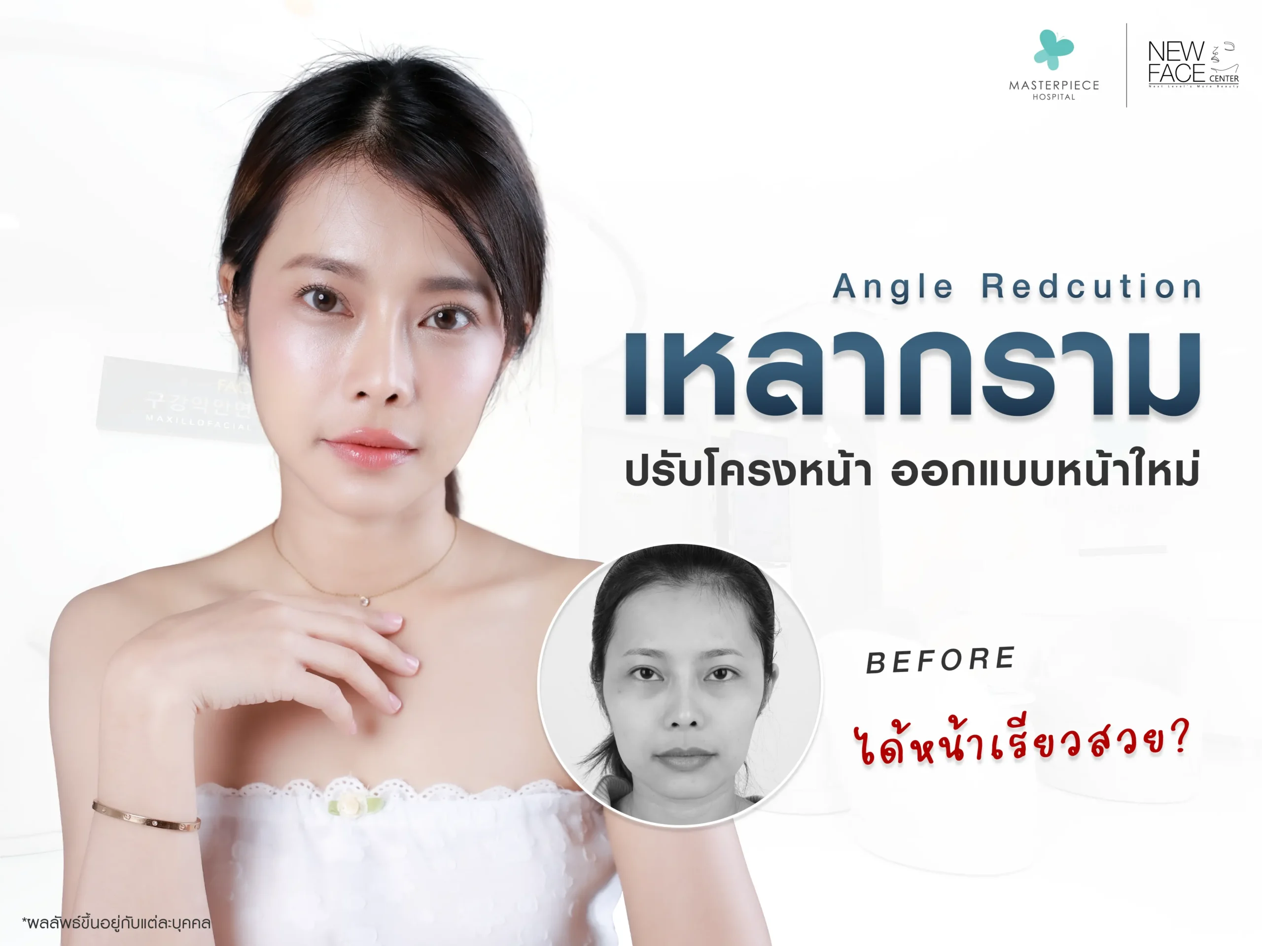 เหลากราม ปรับโครงหน้า ออกแบบหน้าใหม่ ได้หน้าเรียวสวย