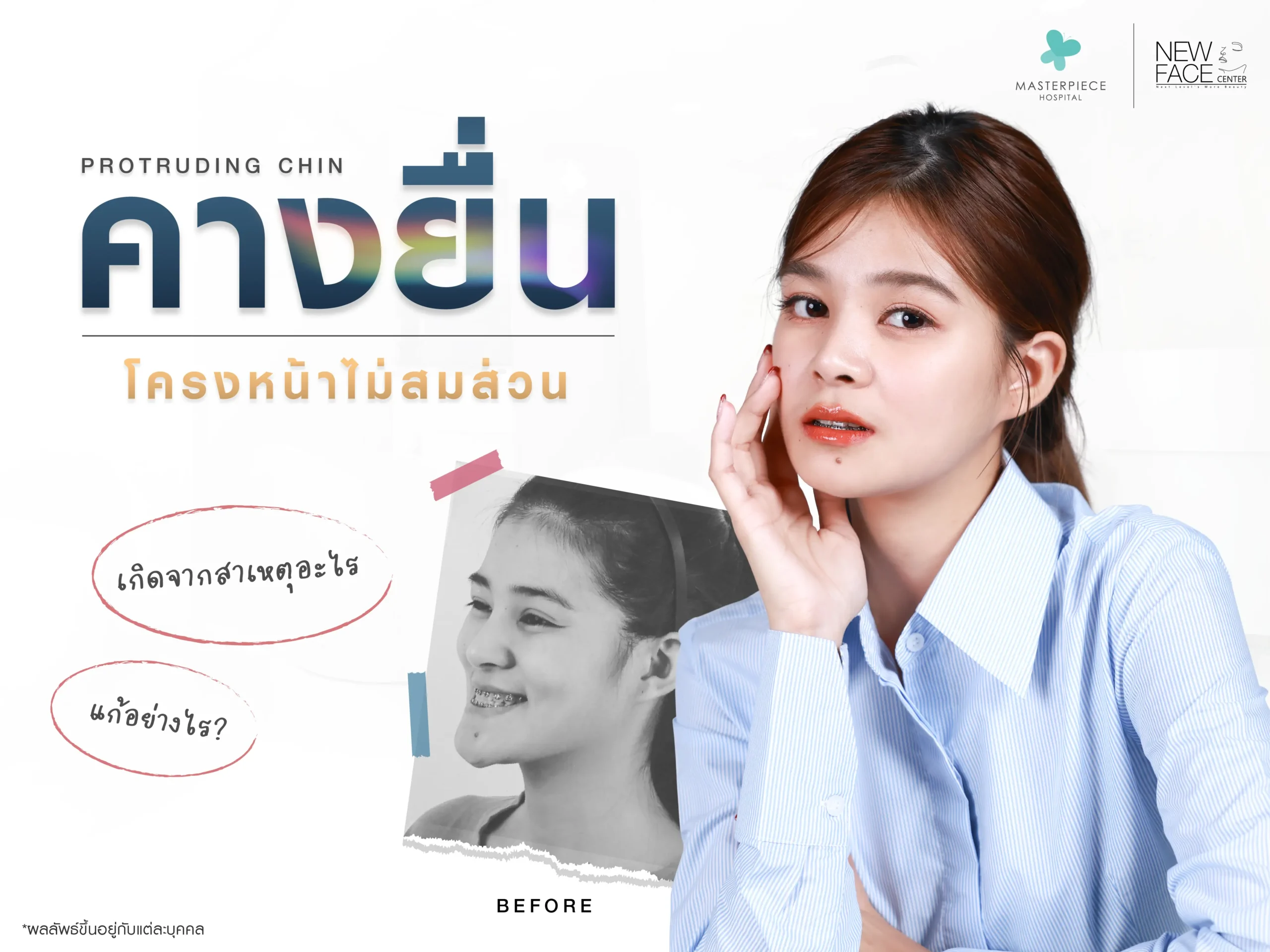 คางยื่น โครงหน้าไม่สมส่วน เกิดจากสาเหตุอะไร แก้อย่างไร?