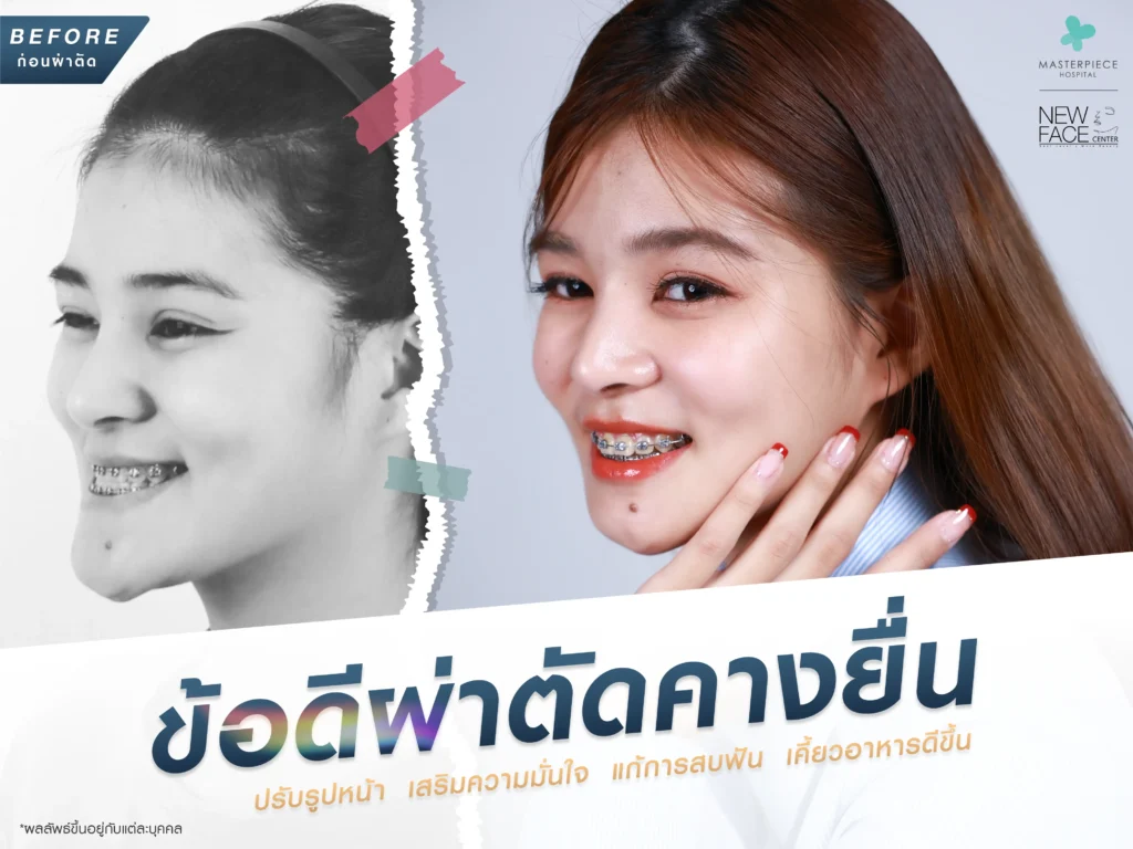 ข้อดีของการผ่าตัดแก้ไขคางยื่น