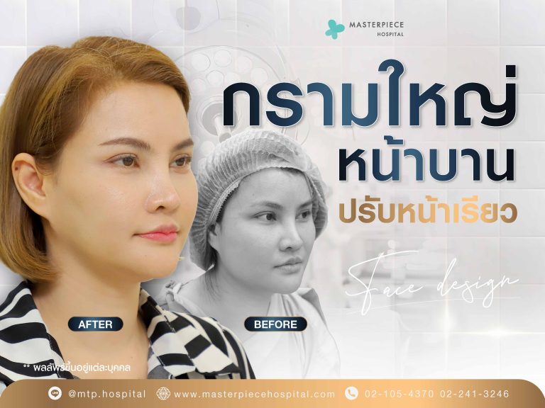กรามใหญ่ หน้าบาน ปรับหน้าเรียว ออกแบบหน้าใหม่ ทำศัลยกรรมครั้งแรก ?