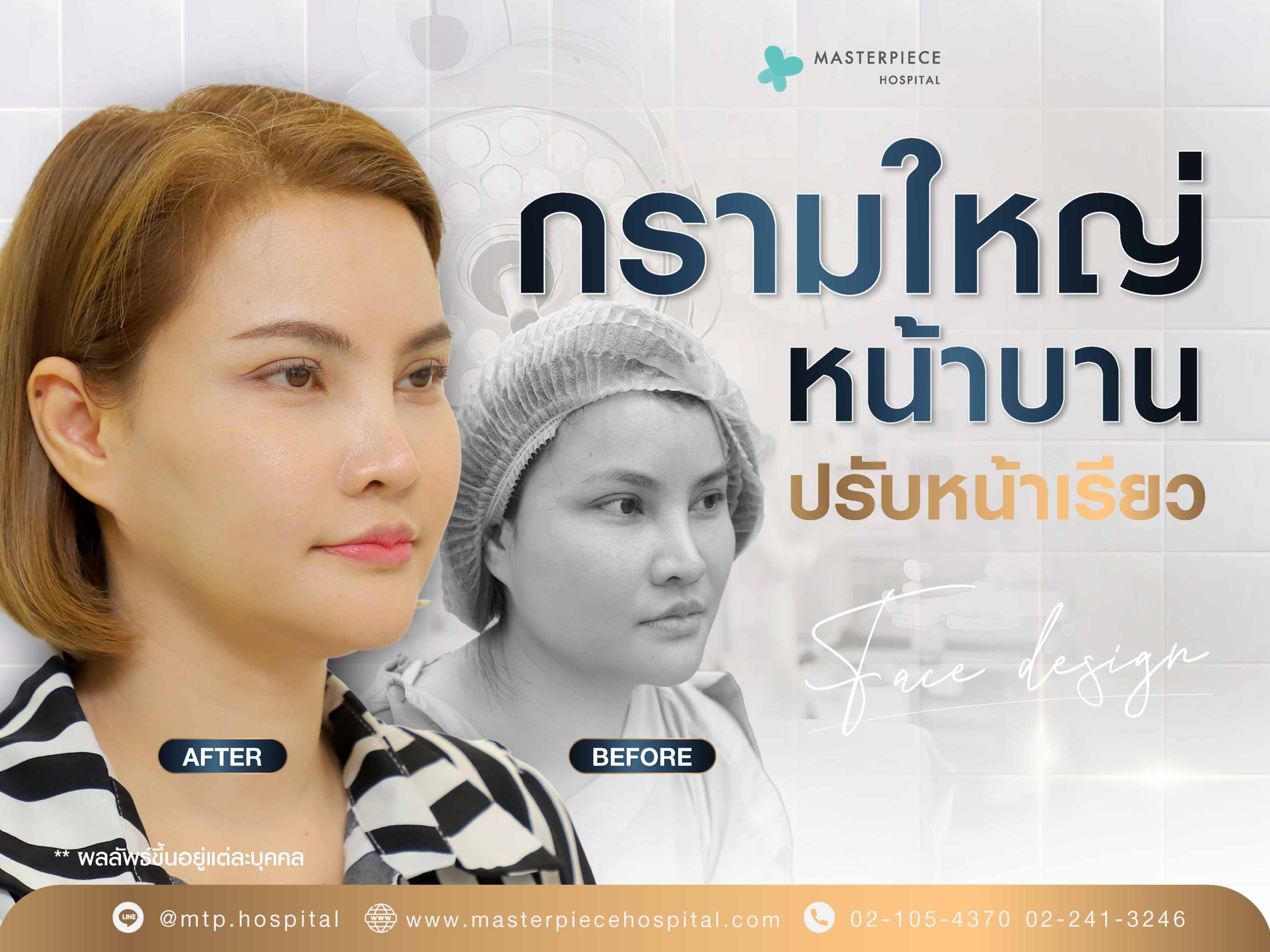 กรามใหญ่ หน้าบาน ปรับหน้าเรียว ออกแบบหน้าใหม่ ทำศัลยกรรมครั้งแรก ?