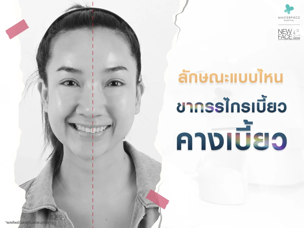 ลักษณะแบบไหน ขากรรไกรเบี้ยว คางเบี้ยว
